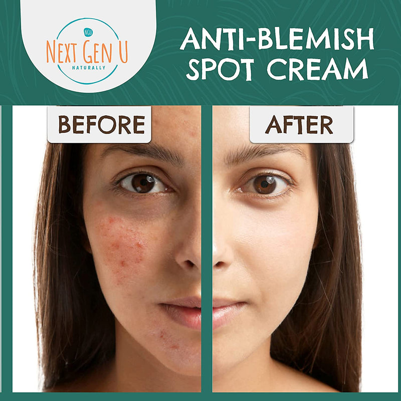 Anti-Blemish Spot Cream 100ml - Helps Reduce Blackheads & Blemishes